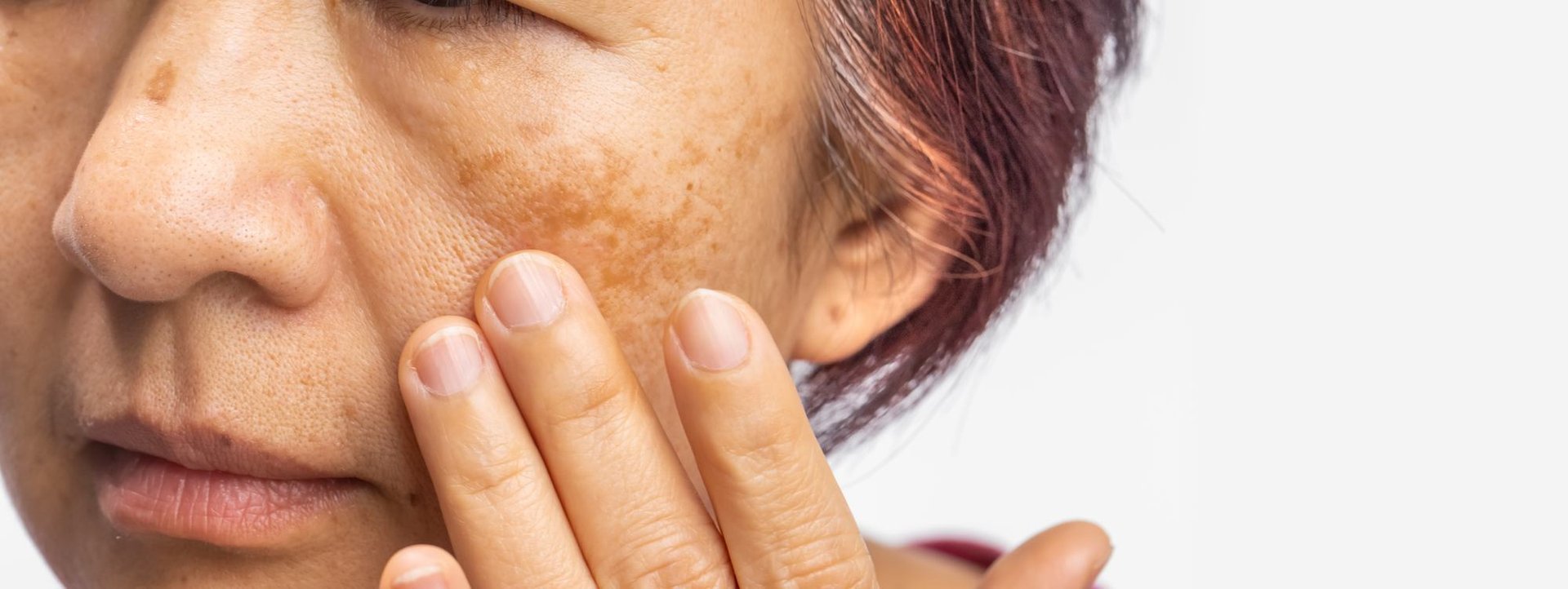 Nahaufnahme einer Frau mit Melasma, die sich das Gesicht berührt
